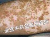 如何治疗白癜风